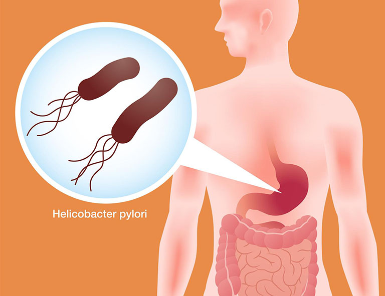 Viêm hang vị dạ dày mãn tính có chữa khỏi không? Lời khuyên từ Lão Tuấn