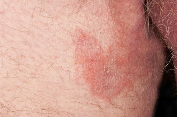 Nổi mẩn đỏ ngứa ở háng nam giới: Đừng coi thường kẻo "họa" vào thân