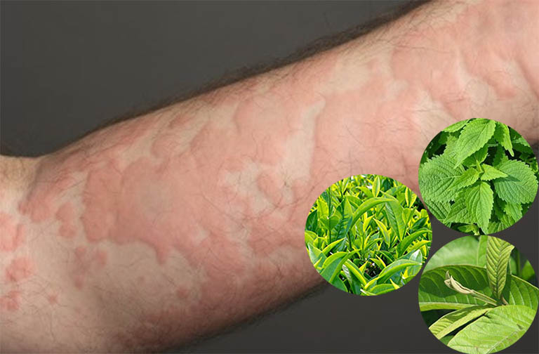 Bị mề đay bôi gì? Gợi ý mẹo dân gian giúp làm dịu nhanh