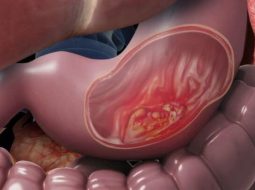 4 biến chứng viêm loét dạ dày nguy hiểm diễn tiến khó lường