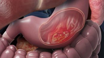 4 biến chứng viêm loét dạ dày nguy hiểm diễn tiến khó lường