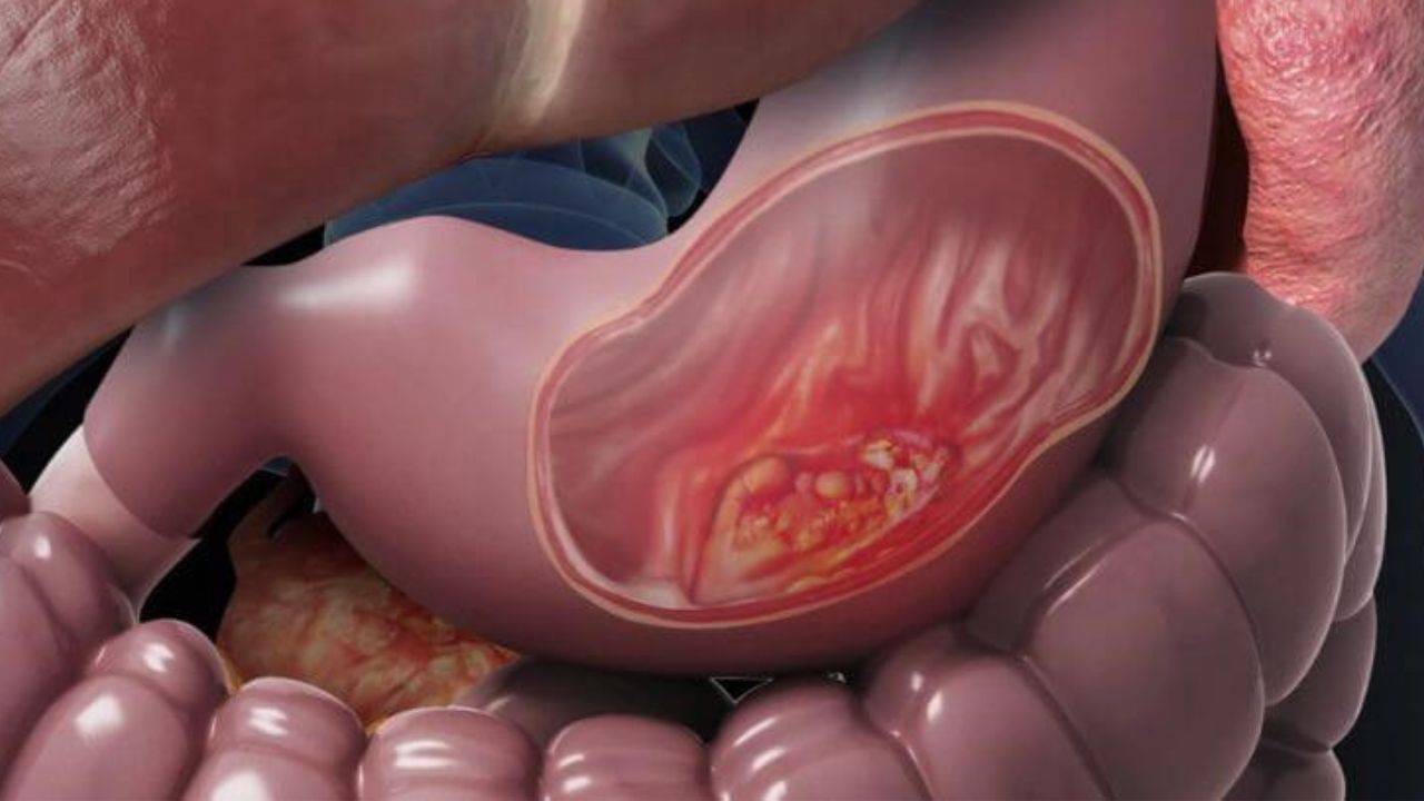 4 biến chứng viêm loét dạ dày nguy hiểm diễn tiến khó lường