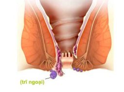 Cách chữa trĩ ngoại hiệu quả, an toàn từ gốc theo Y học cổ truyền