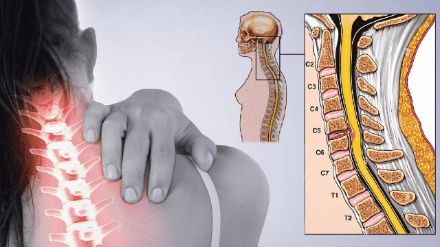 Dấu hiệu thoát vị đĩa đệm cột sống cổ: Đừng để "hóa đá" đôi vai rồi mới trị