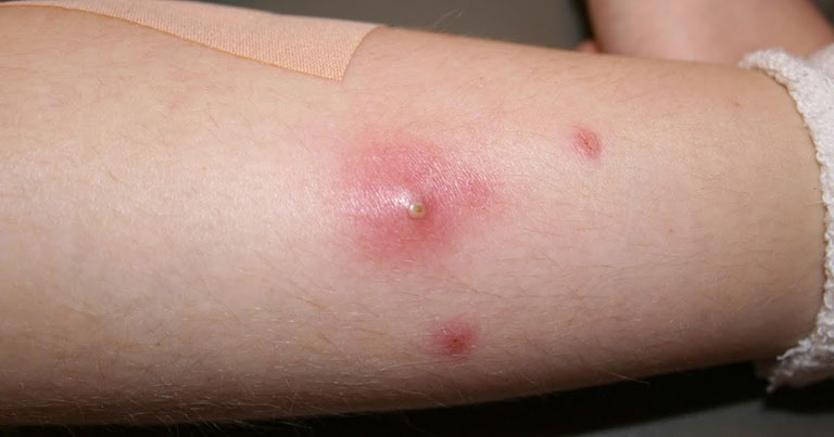 Da nổi mẩn đỏ có mủ ngứa: Coi chừng phong nhiệt độc tụ và cách xử lý từ gốc