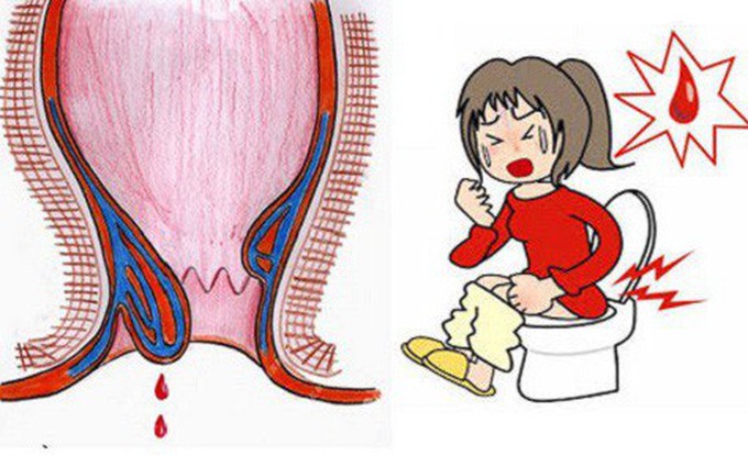 Đi ngoài ra máu tươi nhỏ giọt: Cảnh báo bệnh trĩ và cách xử lý