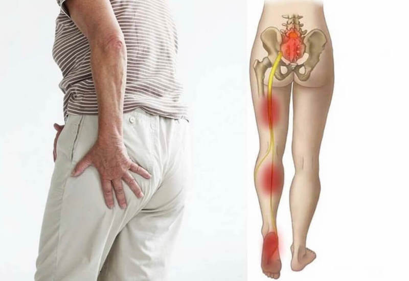 Bà con bị đau thần kinh tọa: Đừng chỉ nằm một chỗ, tập đúng cách mới là "vàng"