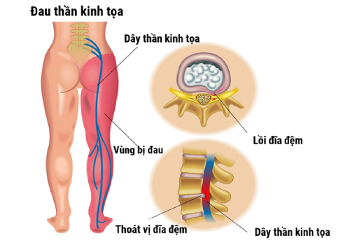 Đau thần kinh tọa