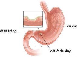 Cách điều trị loét tá tràng dứt điểm từ gốc cho bà con