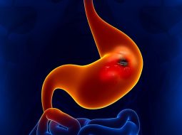 Hậu quả của viêm dạ dày ăn mòn và cách chữa trị tận gốc