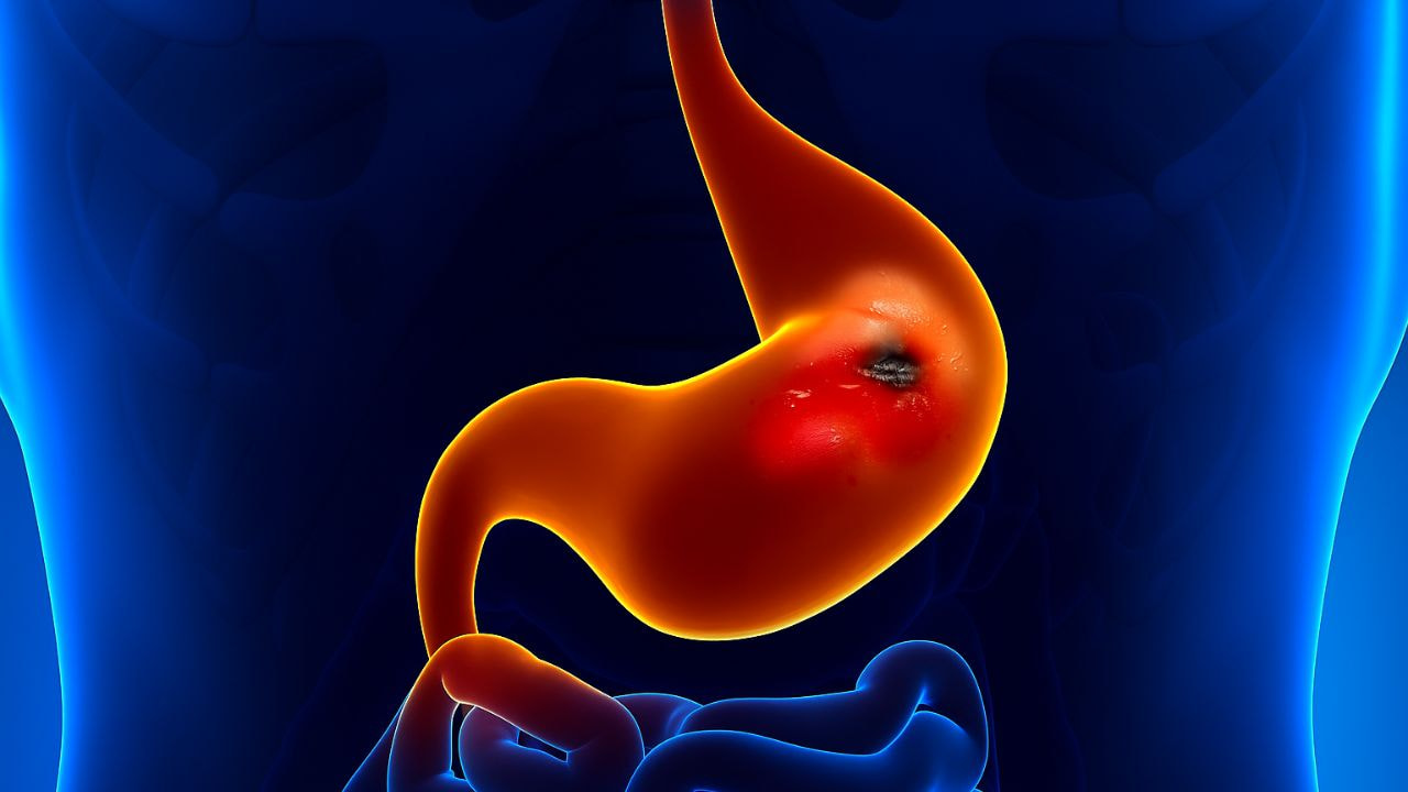 Hậu quả của viêm dạ dày ăn mòn và cách chữa trị tận gốc