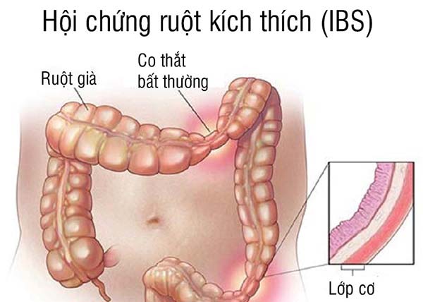 Hội chứng ruột kích thích ở người lớn: Cách Lão Tuấn giúp ổn định tỳ vị