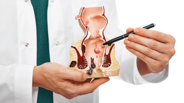 Cách phòng ngừa bệnh trĩ tại nhà hiệu quả từ chuyên gia YHCT