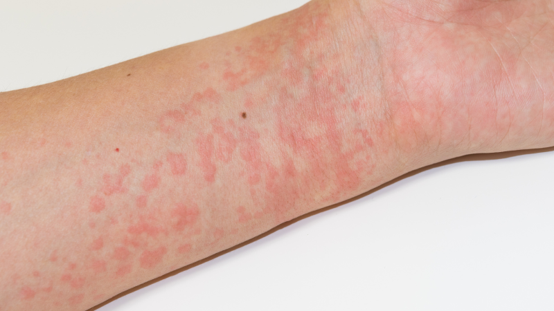 Bị mề đay bao lâu thì khỏi? – Chăm sóc tại nhà sao cho đúng?