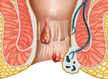 Nhận biết 4 cấp độ bệnh trĩ nội và cách chữa dứt điểm từ gốc rễ