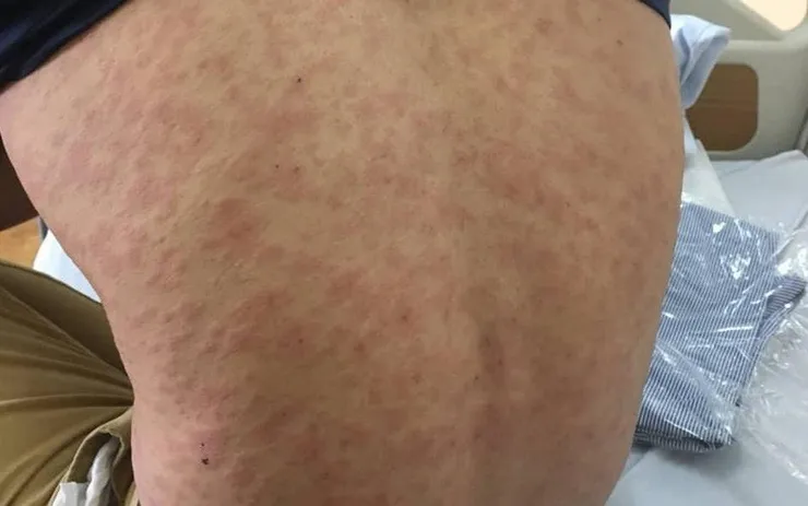 Dị ứng hải sản nổi mề đay: Cảnh báo nguy cơ và cách xử lý từ gốc