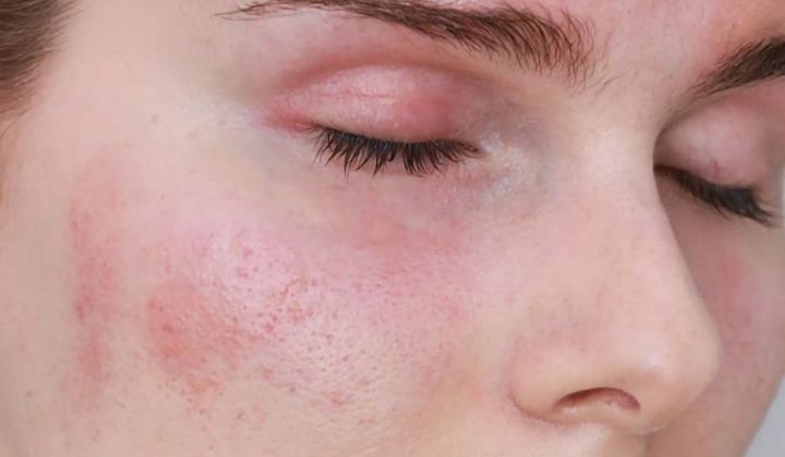 Nổi mề đay quanh mắt: Đừng chủ quan với "cửa sổ tâm hồn" bị phong nhiệt