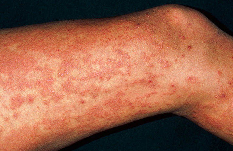 Nổi mề đay vào chiều tối – Chớ coi thường triệu chứng “đến hẹn lại lên”