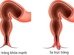 Phân biệt sa trực tràng và trĩ: Đừng nhầm lẫn kẻo rước họa vào thân