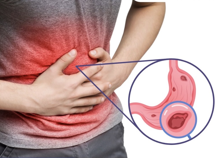 Rối loạn tiêu hóa do viêm loét dạ dày tá tràng: Trị từ gốc mới an