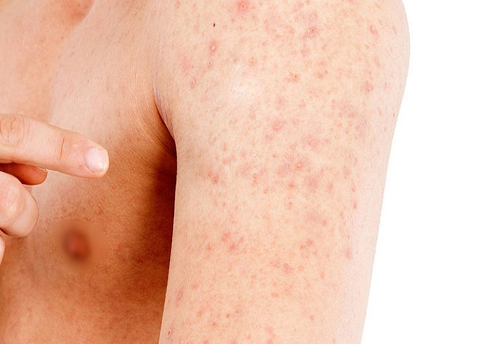 Tay nổi mẩn đỏ không ngứa – Coi thường là mang họa vào thân