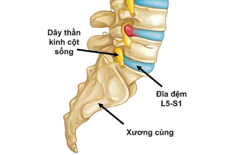 Lồi đĩa đệm L5-S1: Hiểu đúng từ gốc để dưỡng lưng khỏe mạnh