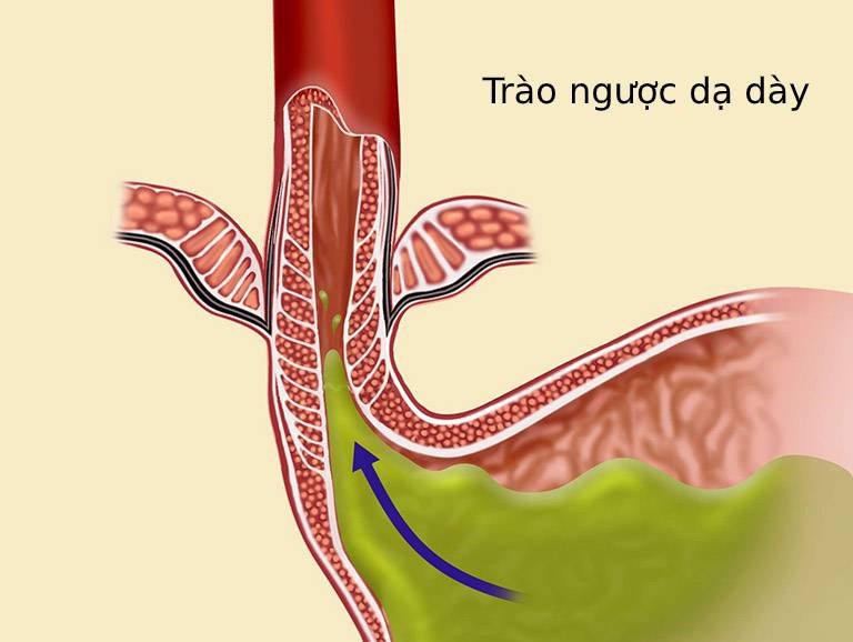 Cách giảm trào ngược dạ dày hiệu quả theo y lý Lão Tuấn