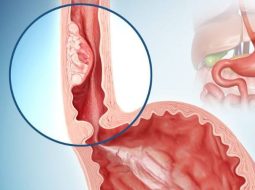 Trào ngược dạ dày có tự khỏi được không? Lời nhắn nhủ từ tâm của Lão Tuấn