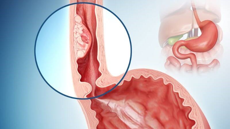 Trào ngược dạ dày có tự khỏi được không? Lời nhắn nhủ từ tâm của Lão Tuấn