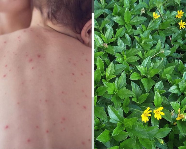 Trẻ bị nổi mề đay tắm lá gì? Lão mách bà con vài cách tắm an toàn