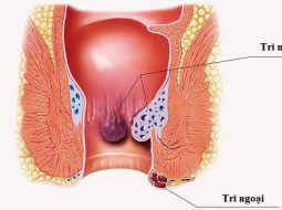 Bệnh trĩ ngoại: Hiểu đúng căn nguyên, chữa tận gốc theo Nam y