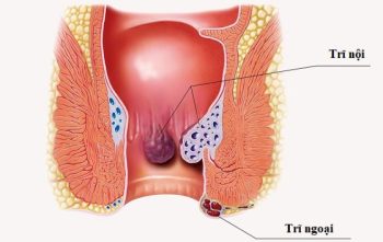 Bệnh trĩ ngoại: Hiểu đúng căn nguyên, chữa tận gốc theo Nam y