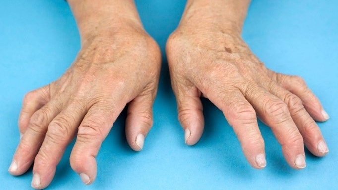 Viêm khớp dạng thấp gây ảnh hưởng gì? Nỗi lo biến dạng và tàn phế