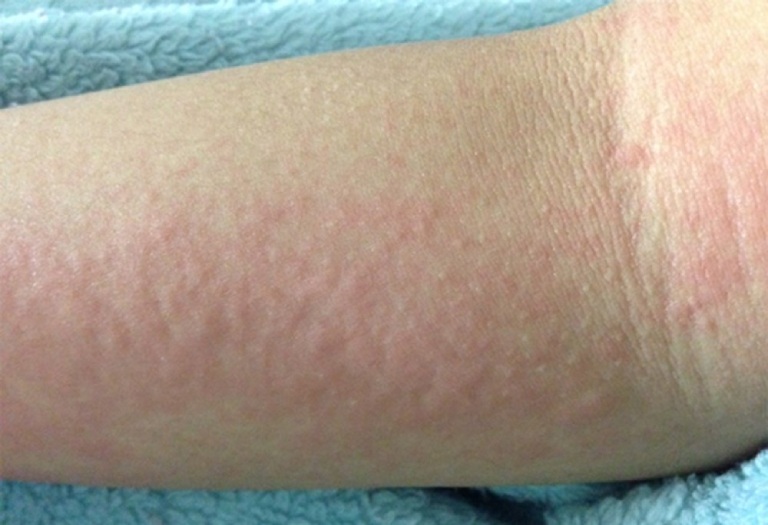 Trời nóng nổi mẩn ngứa: Đừng chủ quan coi thường kẻo rước họa vào thân