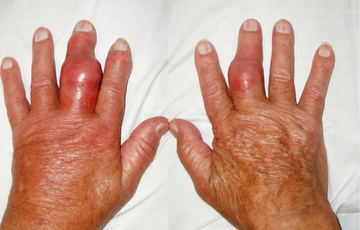 Gout mãn tính có điều trị khỏi hoàn toàn được không và giải pháp từ gốc