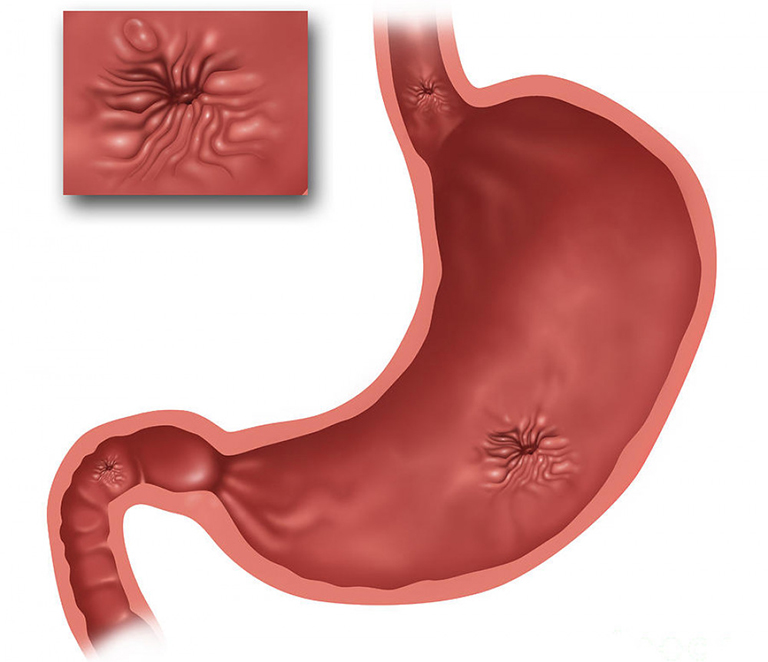 Viêm dạ dày thể teo: Hiểu đúng căn nguyên, trị tận gốc cùng Lão Tuấn