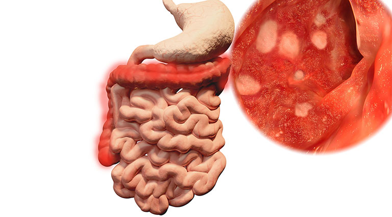 Viêm đại tràng mãn tính: Cách chữa từ gốc giúp bà con ăn ngon ngủ yên