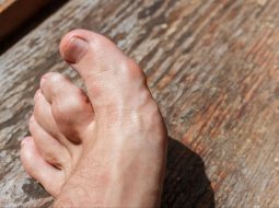 Viêm khớp tinh thể: Nỗi ám ảnh đau nhức bốc hỏa và cách đẩy lùi từ gốc theo Nam y