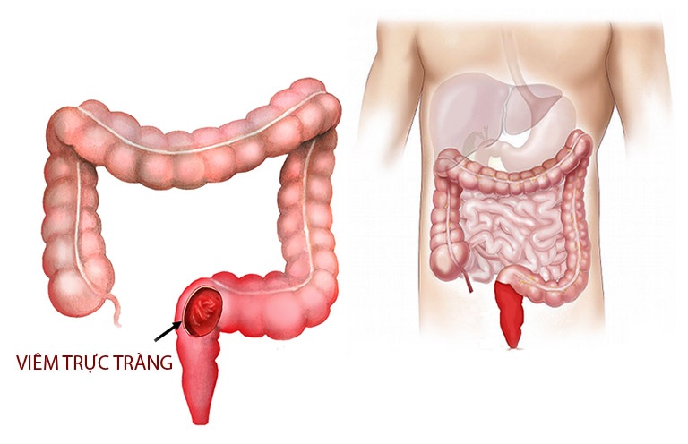 Viêm xung huyết trực tràng: Dấu hiệu và cách trị dứt điểm từ gốc