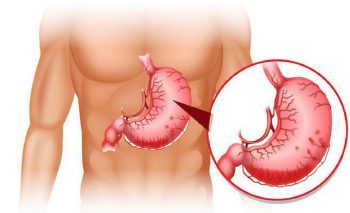 Viêm xung huyết hang vị có khỏi không? Lời dặn từ Lão Tuấn