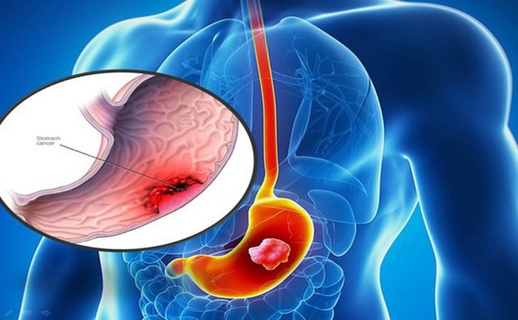 Viêm xung huyết hang vị dạ dày có nguy hiểm không và cách chữa