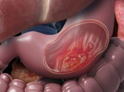 Cảnh giác với loét dạ dày: Đừng để thói quen nhỏ gây hậu họa lớn