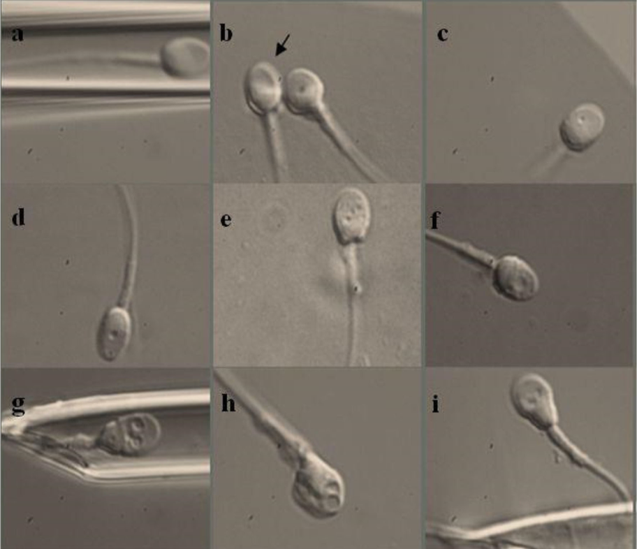 Tinh trùng bị dị dạng có chữa được không? Lời giải từ Lão Tuấn