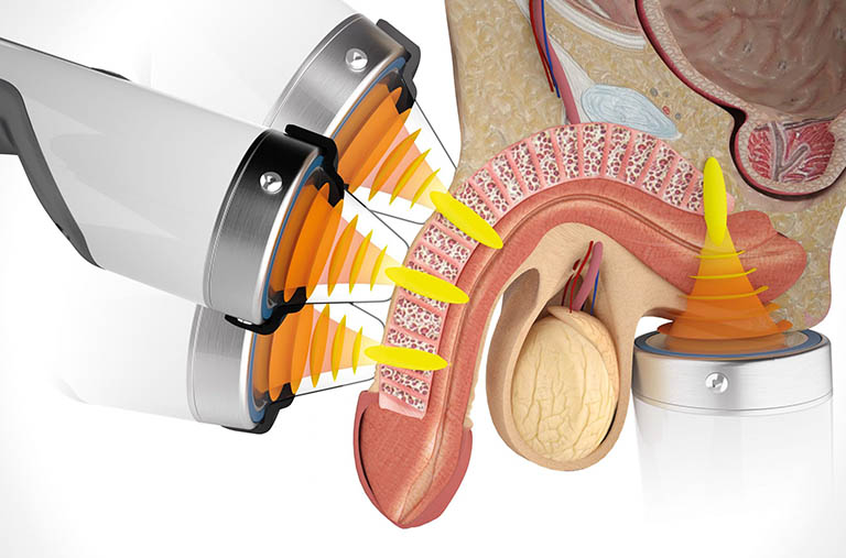 Điều trị rối loạn cương dương bằng sóng xung kích: Lời dặn từ Lão Tuấn