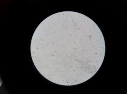 Tinh trùng bị lỏng: Nỗi lo thầm kín và cách lấy lại bản lĩnh nam nhi