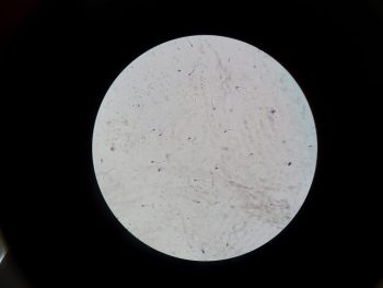 Tinh trùng bị lỏng: Nỗi lo thầm kín và cách lấy lại bản lĩnh nam nhi