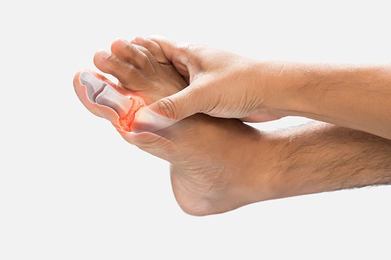 Bệnh gút có ảnh hưởng đến tinh trùng? Lời cảnh báo cho Anh Em