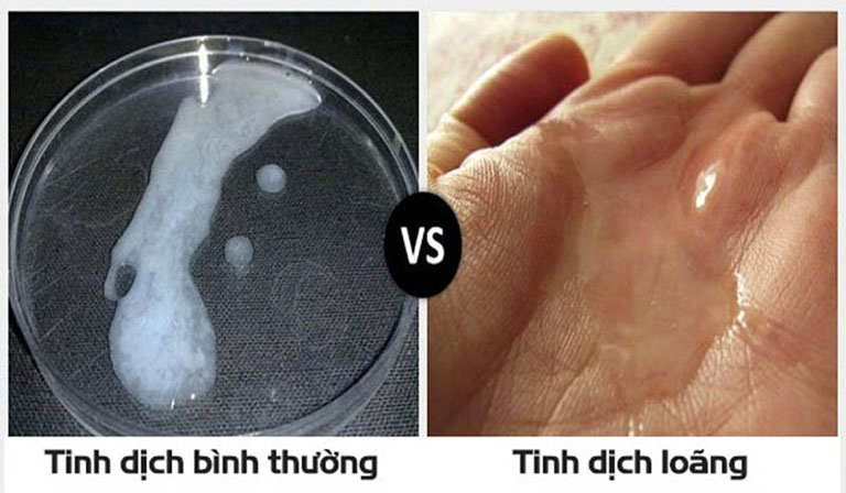 Dấu hiệu tinh trùng yếu: Bí quyết giữ gốc Thận, vẹn tròn bản lĩnh