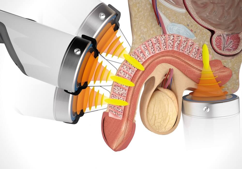 Điều trị xuất tinh sớm bằng sóng cao tần: Lợi hay hại, thưa Anh Em?