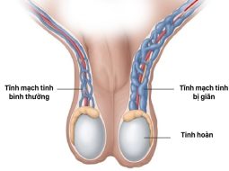 Giãn tĩnh mạch tinh có gây yếu sinh lý? Lời đáp từ Lão Tuấn